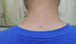 颈部下方长痣代表什么 脖子上有痣代表什么