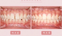 山西太原口腔医院：牙齿有很多缝隙，牙缝过大该怎么办？散在间隙的4大危害