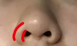 鼻翼肥大的鼻子应该如何改善？