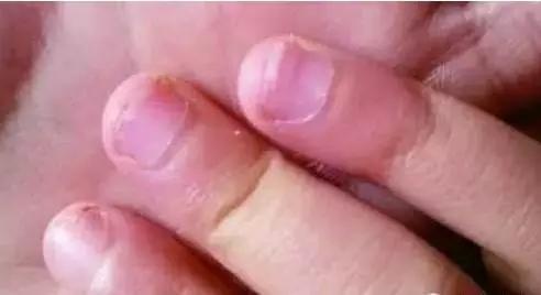 指甲长坚纹是为什么？