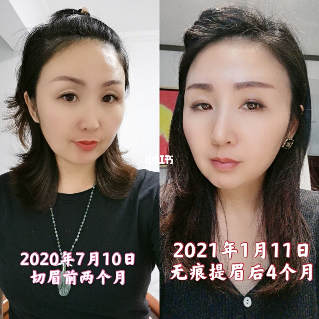 额头窄太阳凹陷发型_额头窄太阳凹陷命不好_女人额头窄命苦吗