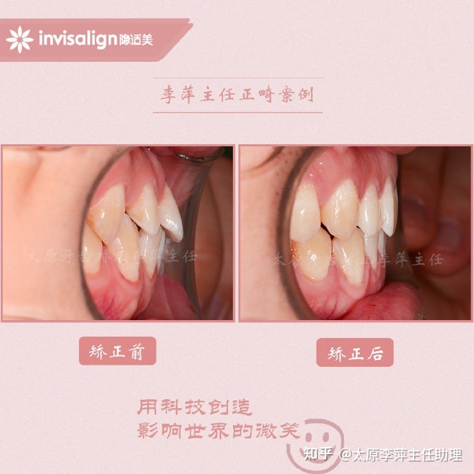 牙齿有缝隙_牙齿有缝隙还能好吗_牙齿疏松有缝隙怎么办